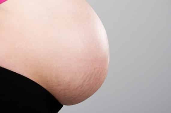 prevenir-estrias-en-el-embarazo