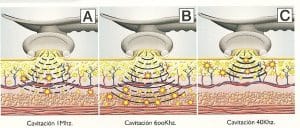 cavitacion ultrasonido