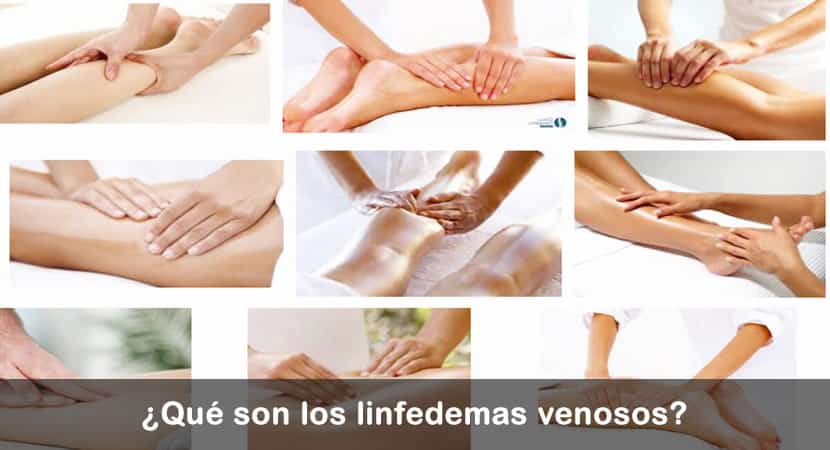 linfedemas venosos imagenes