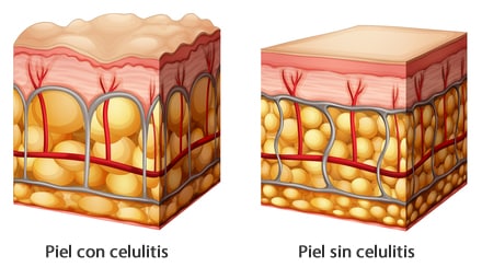 piel con celulitis